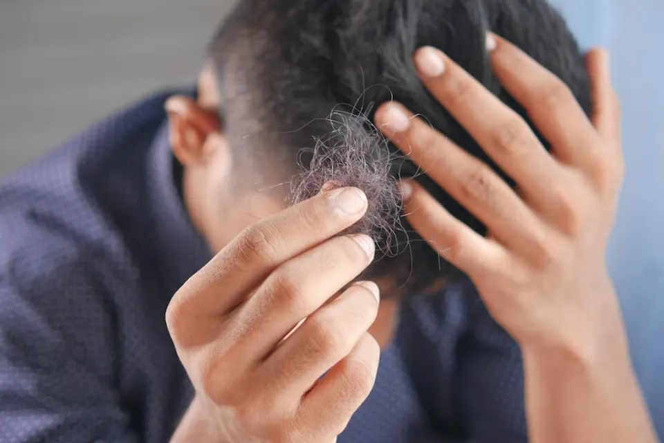 Testosterone And Hair Loss - How Does Testosterone Affect Hair?