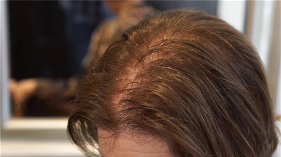 Will Lisinopril Cause Hair Loss
